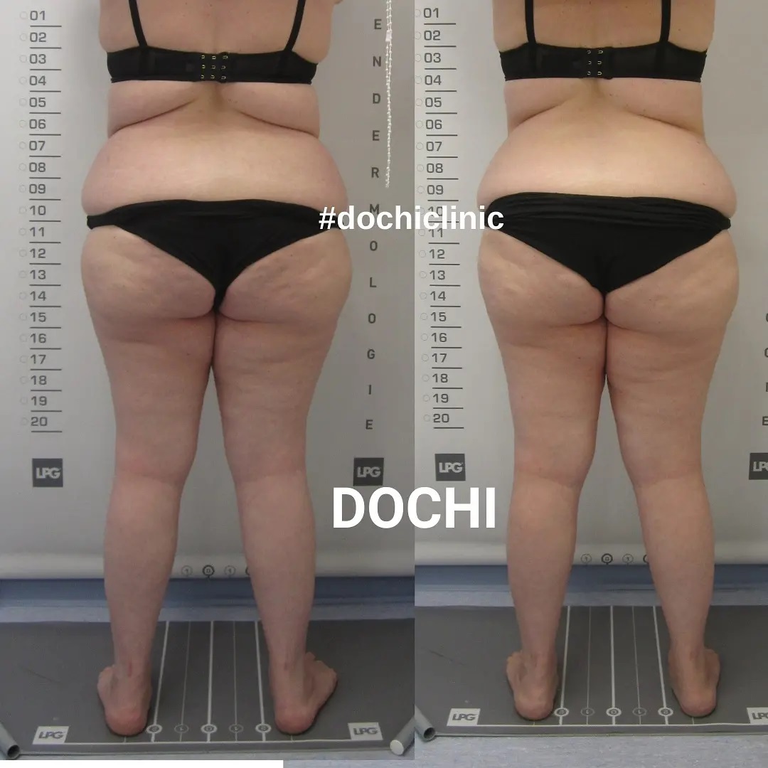 LPG-endermologie-Dochi-Soins_corps-resultat